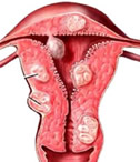 Image Result For Ulcers Image Result For Ulcers